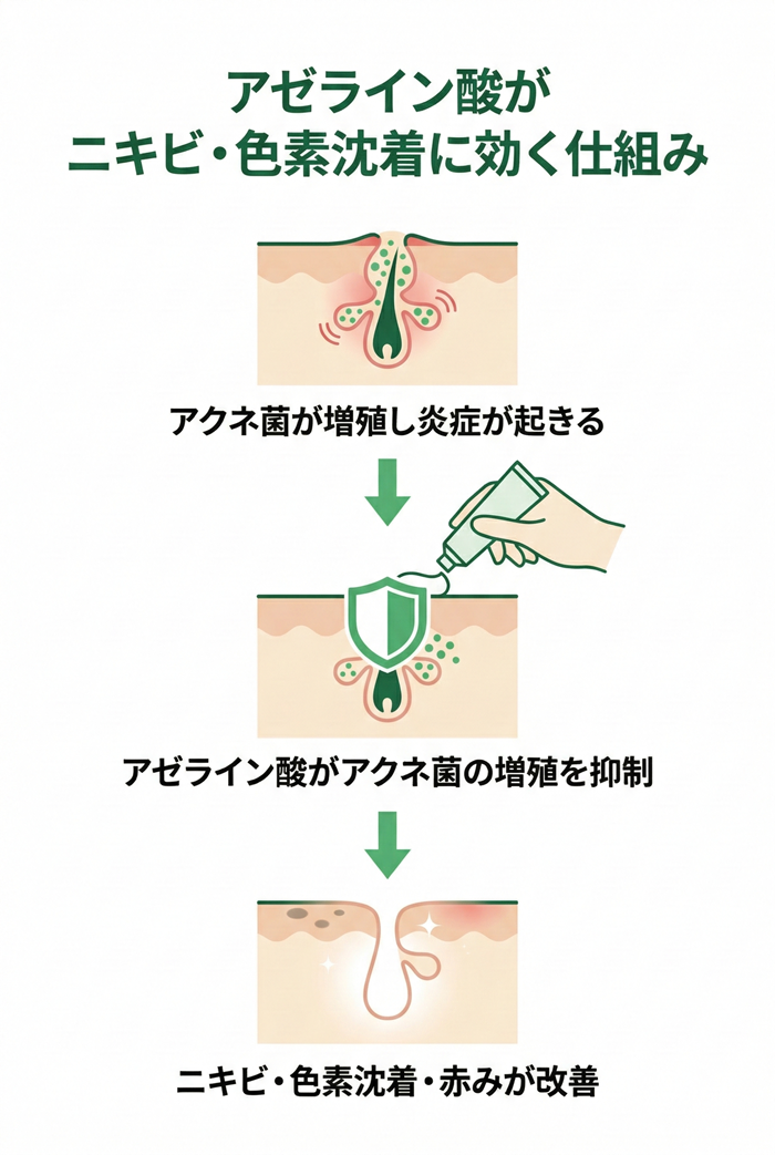 スキノレンクリームとは